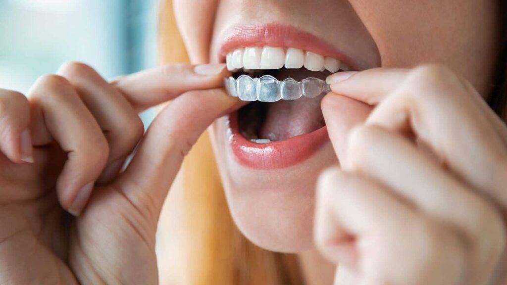 Invisalign Aftercare