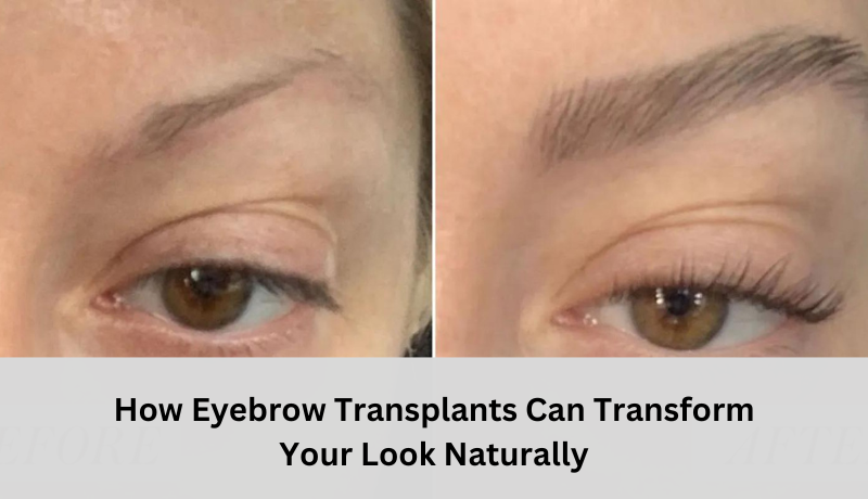 eyebrow transplants