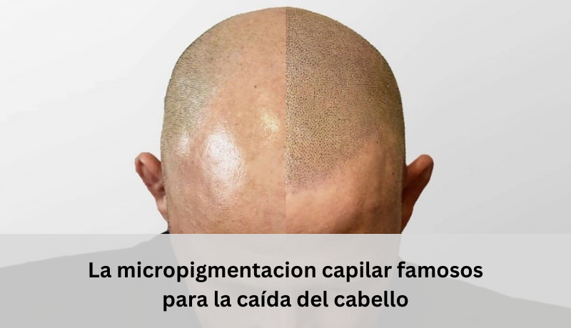 micropigmentacion capilar famosos