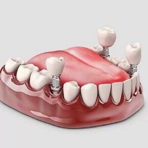 dental implant in Islamabad