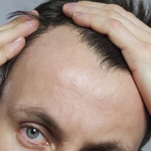 hair loss in Islamabad