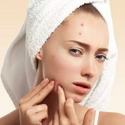 acne treatment in Islamabad