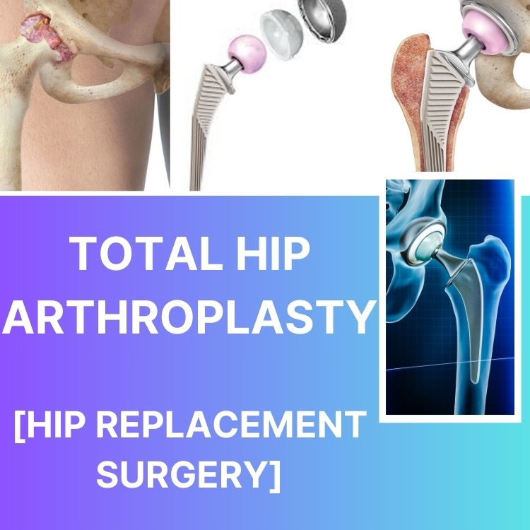 Total Hip Arthroplasty [Hip replacement surgery]