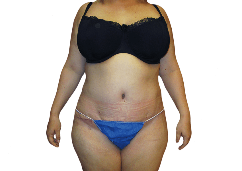 Tummy Tuck Houston
