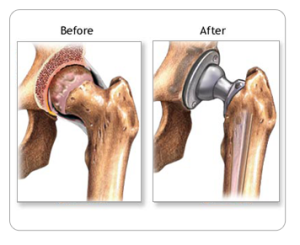 Hip Replacement Surgery