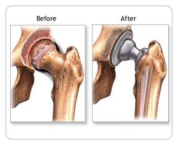 Hip Replacement Surgery