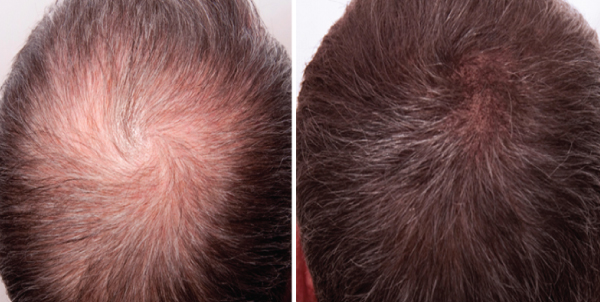 microneedling for hair loss