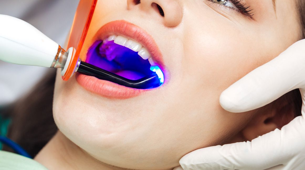 Composite fillings Houston