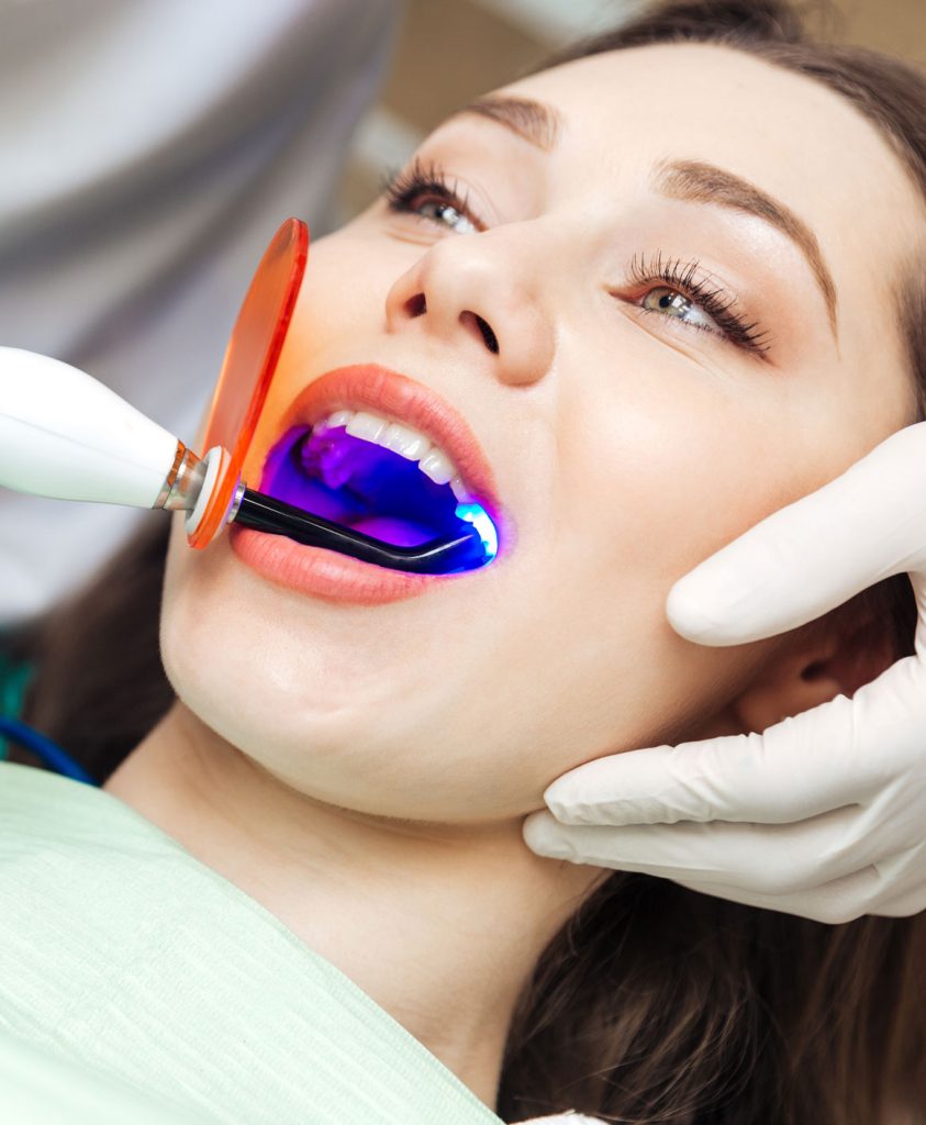 Composite fillings Houston