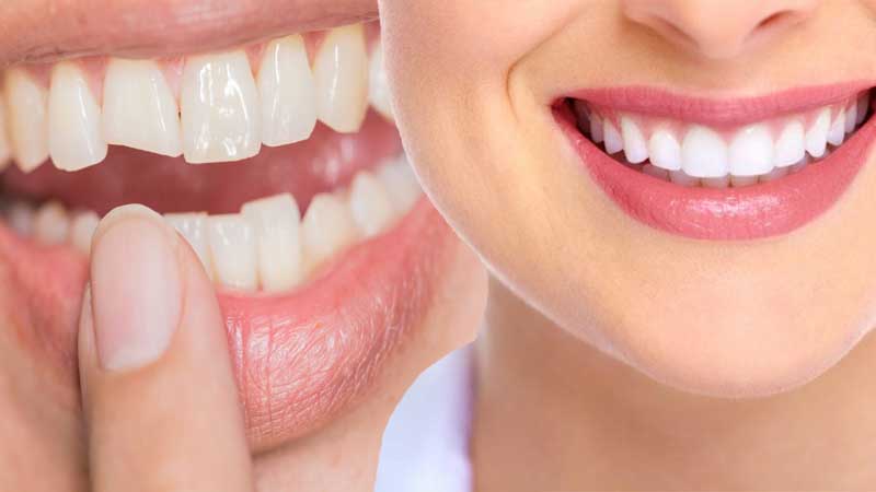 Dental Bonding Near Me