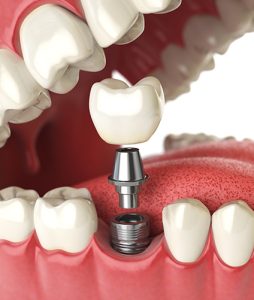 affordable implant dentist