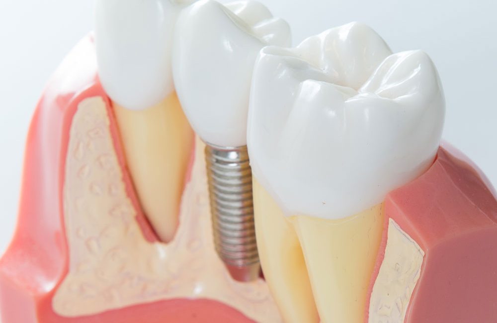 best veneers houston