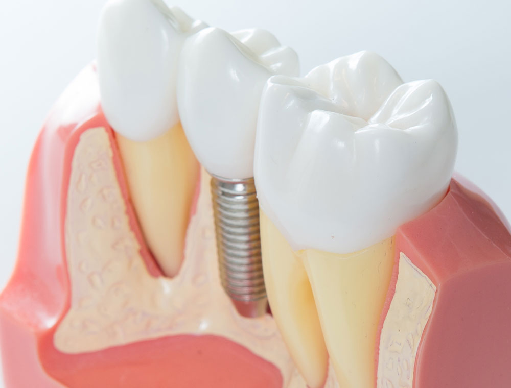 best veneers houston