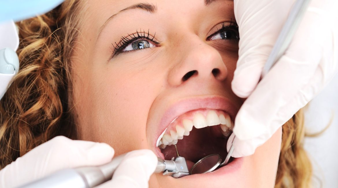 houston texas veneers