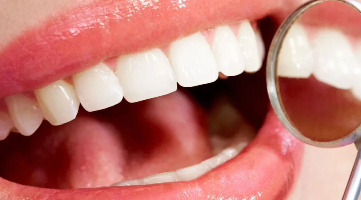 best veneers houston