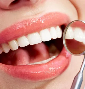 best veneers houston