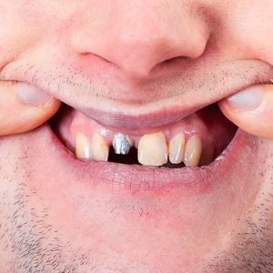 Dental Implant Tooth