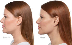 Kybella