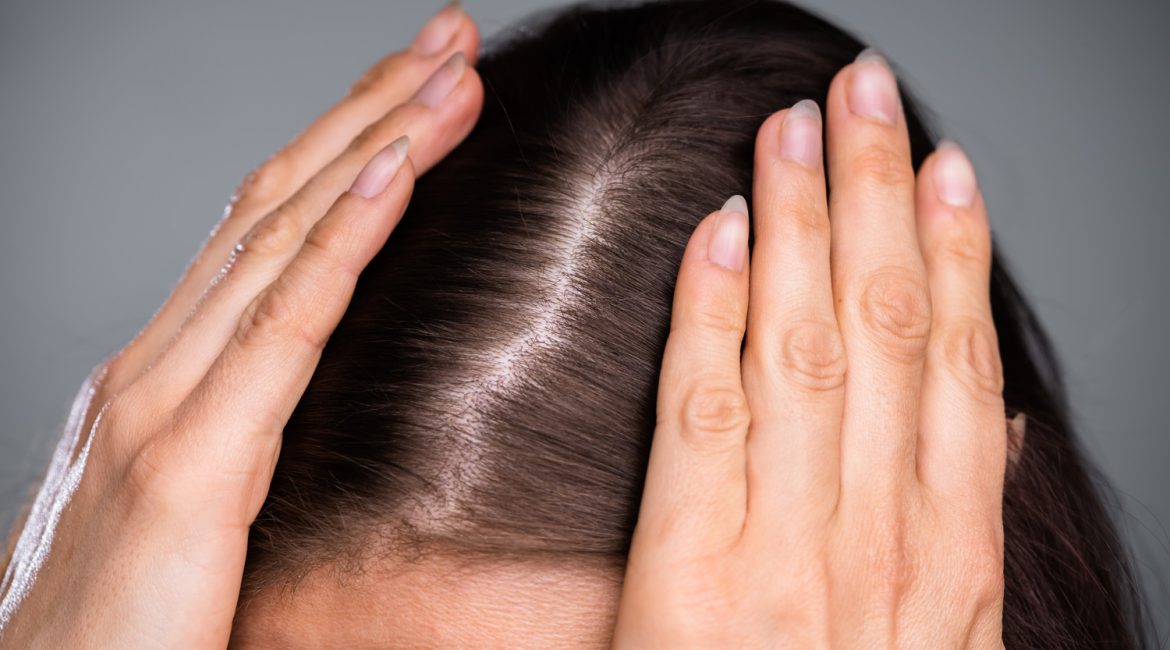 adderall hair loss
