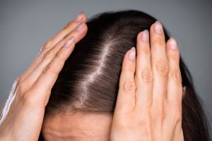 adderall hair loss