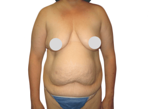 Mommy Makeover
