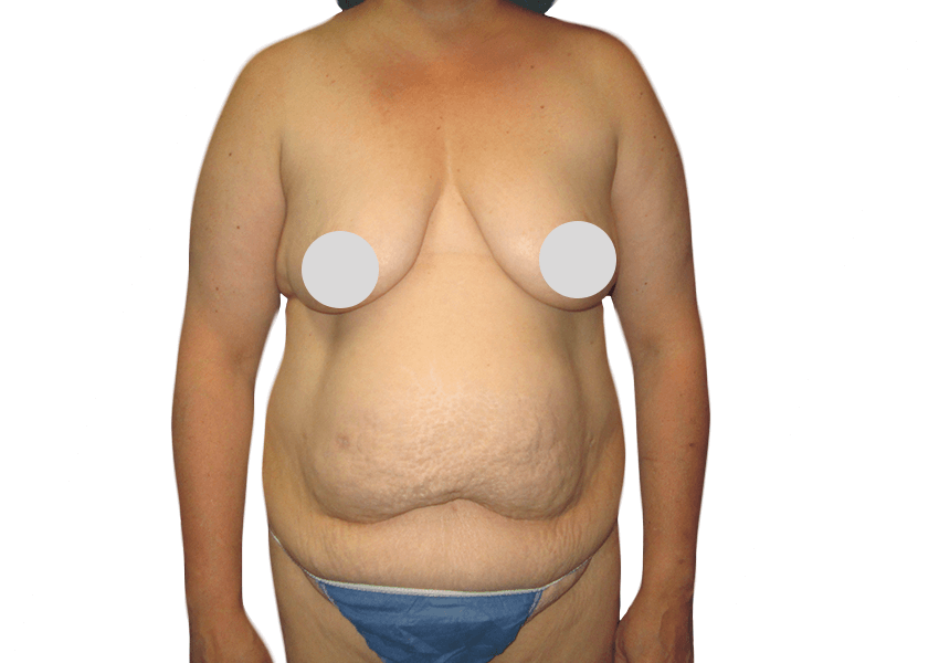 Mommy Makeover