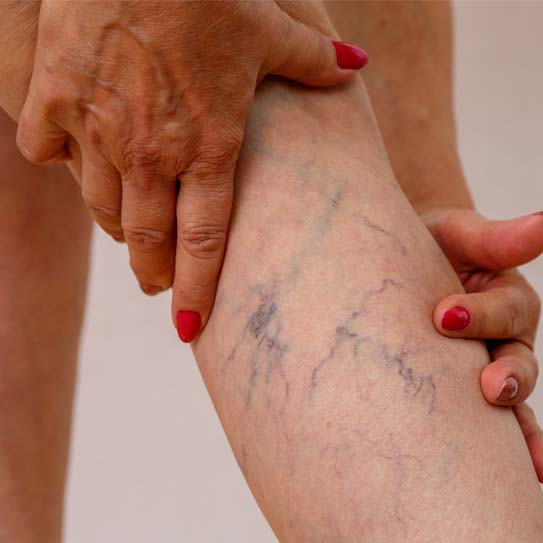 California Vein Treatment Center