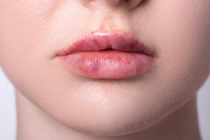 lip fillers in islamabad