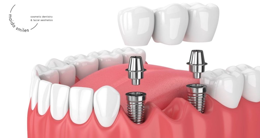 cheap crowns for teeth