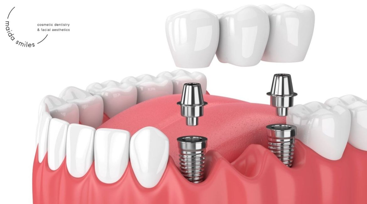 cheap crowns for teeth