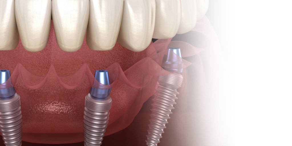 dental implants new york city