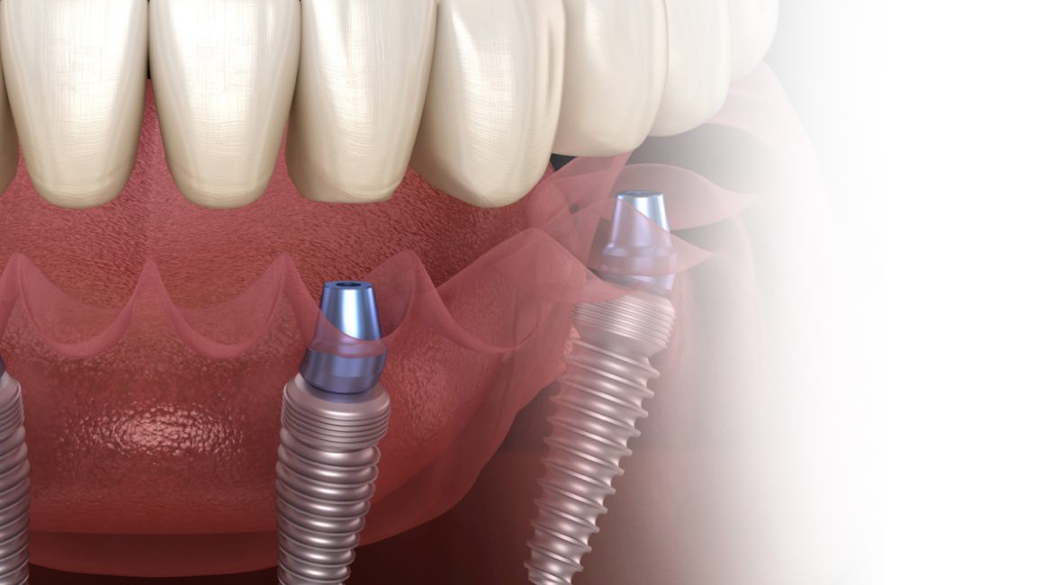 dental implants new york city