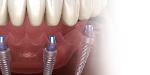 dental implants new york city