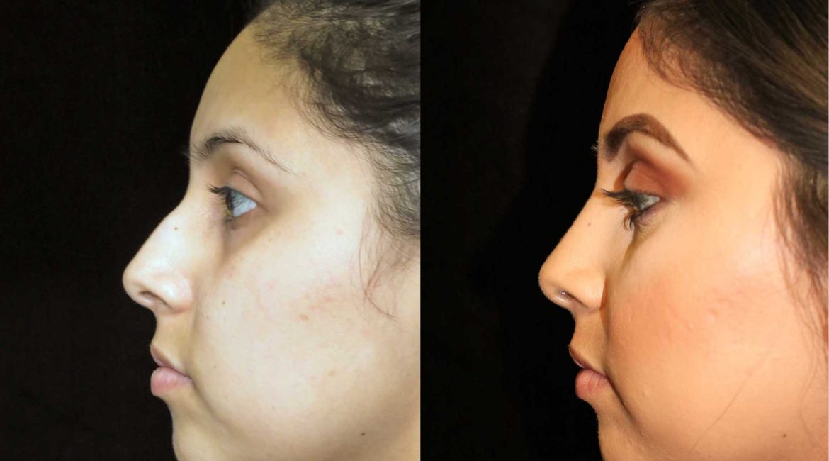 عملية تجميل الأنف في الرياض