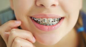Dental Braces in Islamabad