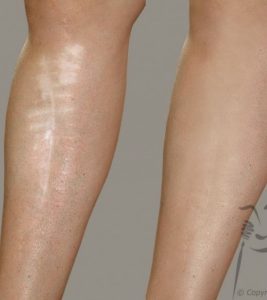 Laser Scar Removal in Riyadh