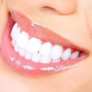 Laser Teeth Whitening in Islamabad