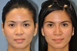 Non-Surgical Nose Job in Islamabad