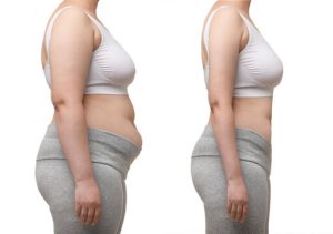 Weight Loss Treatment in Islamabad