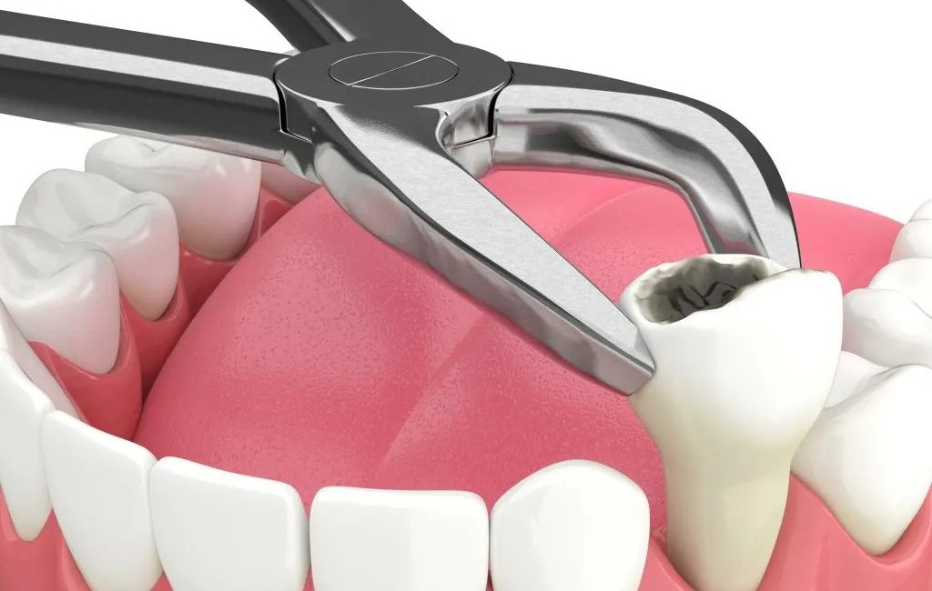 tooth extraction cost in Dubai