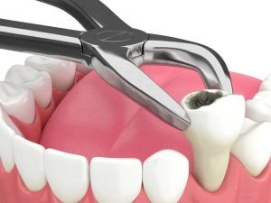 tooth extraction cost in Dubai