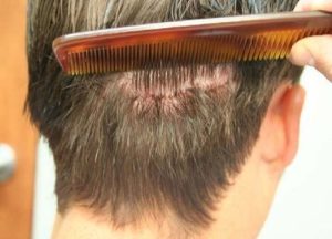 Hair Transplant Riyadh