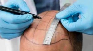 Hair Transplant in Riyadh