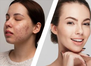 Acne Treatment In Islamabad