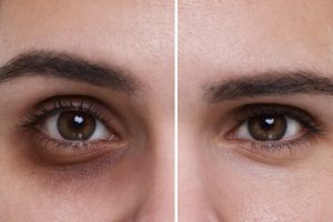 Dark Circles Treatment in Islamabad