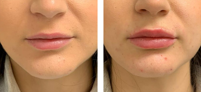 Lip Enlargement in Riyadh