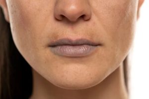 Smoker Lips Treatment in Islamabad