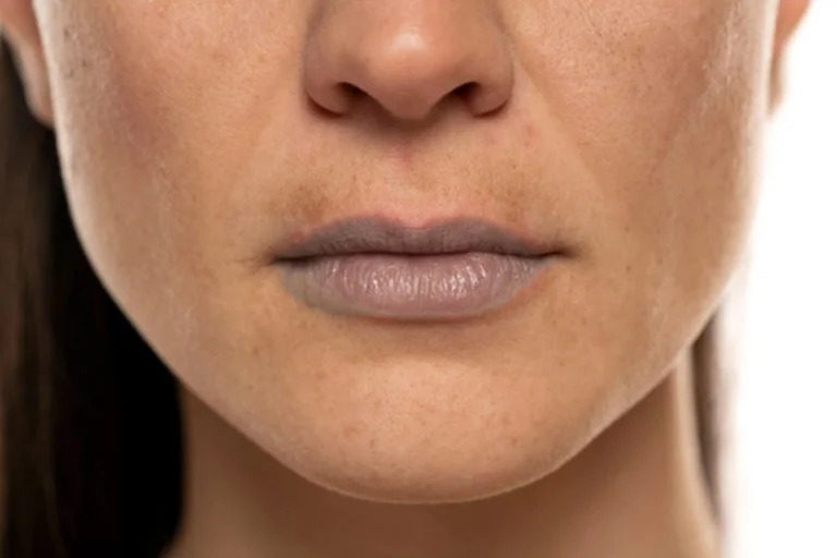 Smoker Lips Treatment in Islamabad