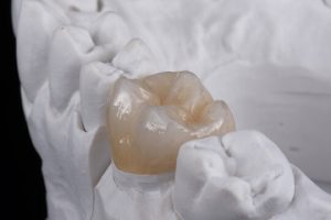 Zirconia Crown in Islamabad