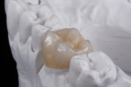 Zirconia Crown in Islamabad